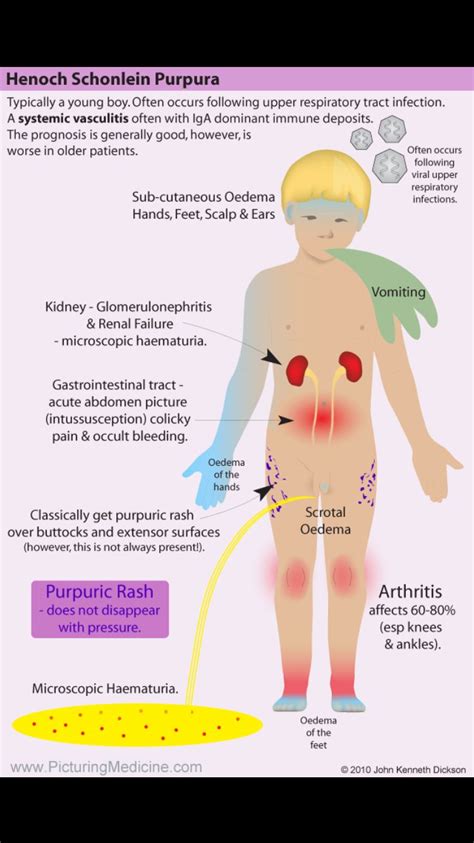 Henoch Schonlein Purpura Symptoms