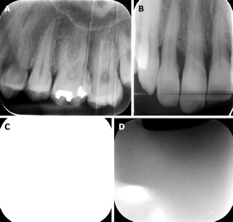 Analysis Of Photostimulable Phosphor Image Plate Artifacts And Their