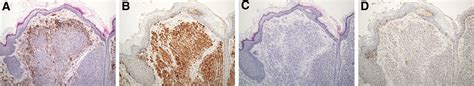 Clinical Characteristics Of Intradermal Nevus In The Externa Medicine