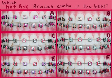 Light Pink Braces