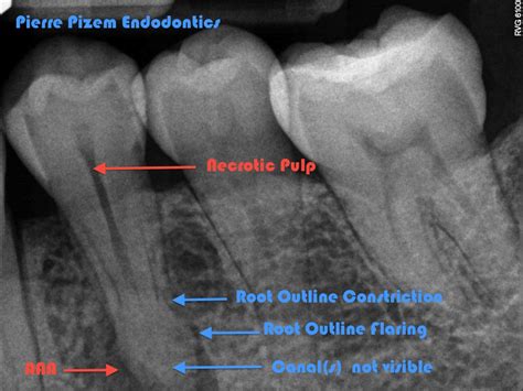 Dental Pulp Necrosis Dental Pulp Gangrene Dental Pulp Autolysis