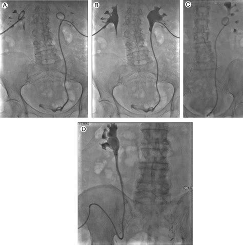 Urinary Drainage Procedures In Interventional Radiology Techniques In