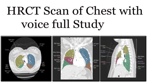 Hrct Scan Of Chest Full Study Youtube