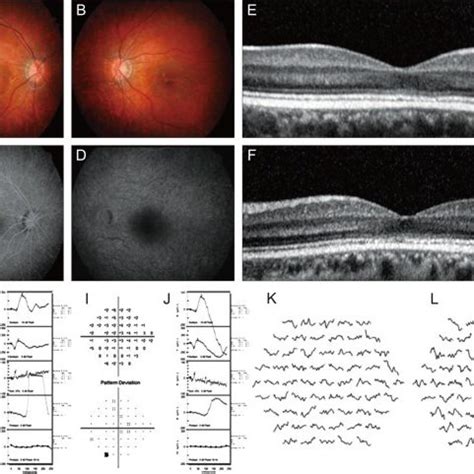 A Year Old Man Case With Cone Dystrophy A B Fundus