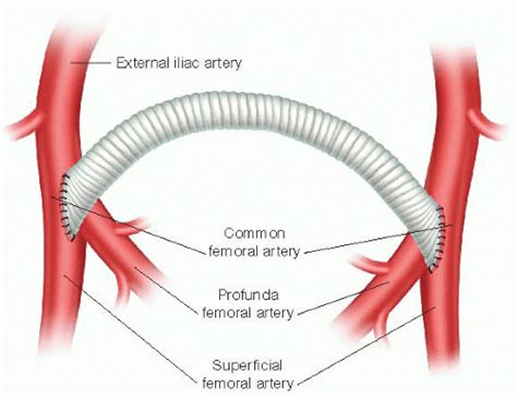 Occlusive Disease Management Isolated Femoral Reconstruction Aortofemoral Open Reconstruction