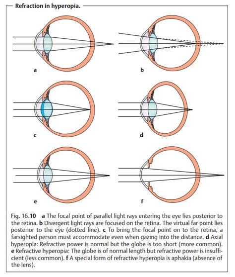 Hyperopia Farsightedness