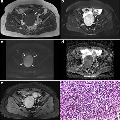 Magnetic Resonance Imaging Of A Large Ovarian Tumor Arrows A Axial Download Scientific