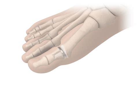 Biopro Hemi Toe Implant For Hallux Rigidus