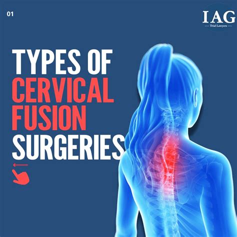 Cervical Fusion Settlements Verdicts Updated For 2022