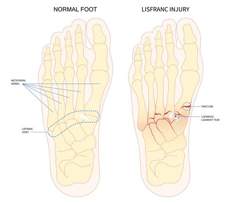 Subtle Lisfranc Injury: Symptoms & Consequences if Missed | Dr HC Chang