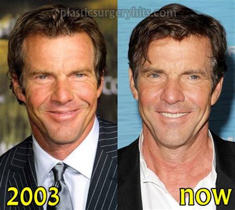 Dennis Quaid Debatable Plastic Surgery Before And After