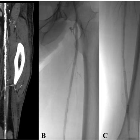 Preoperative Ct Angiography Showing Atherosclerotic Disease And