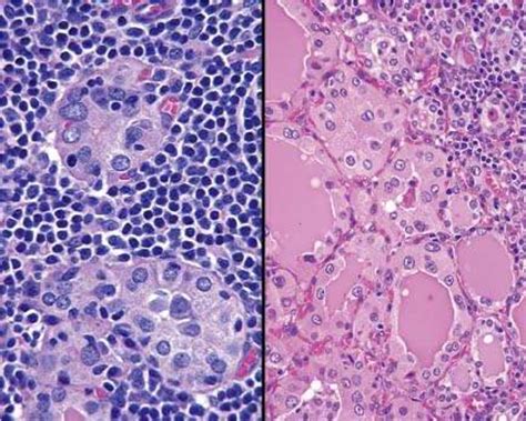 Figure 2 From Chronic Lymphocytic Thyroiditis Hashimoto Thyroiditis Semantic Scholar