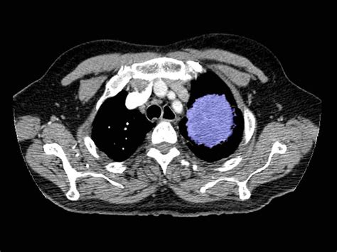 Why Some Doctors Hesitate To Screen Smokers For Lung Cancer : Shots - Health News : NPR