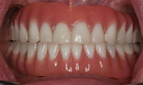 Dentures Medina OH Complete Your Smile With Frontier Dental