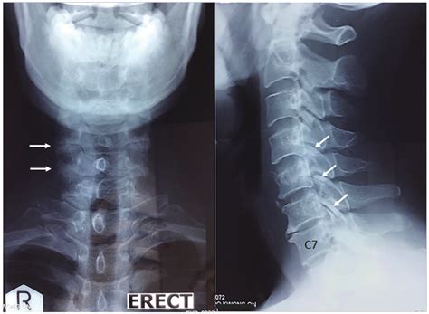 Anterior And Lateral Views Of The Cervical Spine Cervical Radiographs