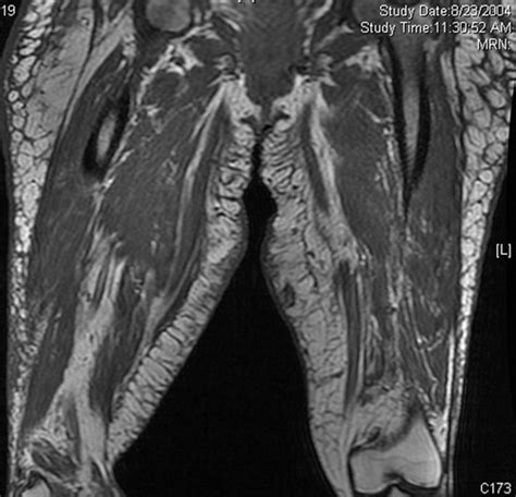 Nephrogenic Systemic Fibrosis And Its Impact On Abdominal Imaging Radiographics