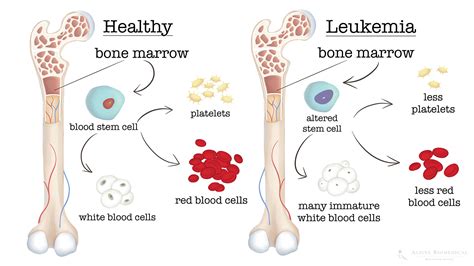 Leukemia Symptoms Causes Diagnosis And Treatment Alpine Biomedical