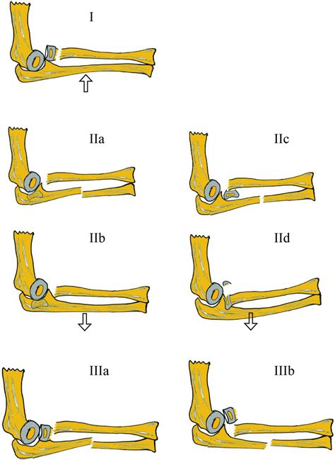 Monteggia Equivalent Lesion In Children A Narrative Review World