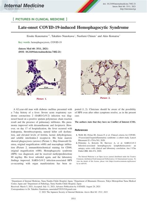 Late Onset COVID 19 Induced Hemophagocytic Syndrome