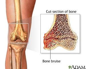 Knee Bone Bruise – The Disabled List