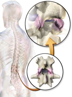 Facet Joint Syndrome - Physiopedia