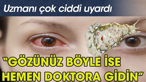 Bu Belirti G Z N Zde Varsa Acil Doktora Gidin