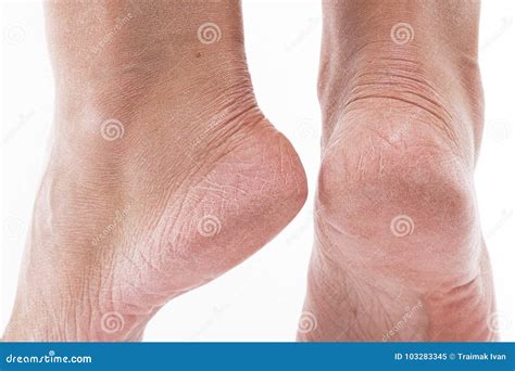 Dehydrated Skin On The Heels Of Female Feet Stock Image Image Of