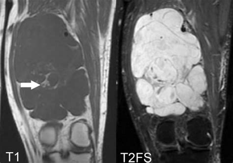 Multidisciplinary Management Of Soft Tissue Sarcoma Radiographics