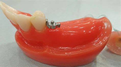 Комбинирано протезиране във Варна | Dunev Dental Lab