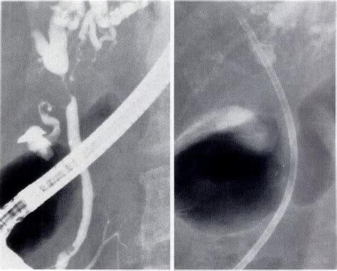 A Endoscopic Cholangiogram Shows A Malignant Stricture Of Common