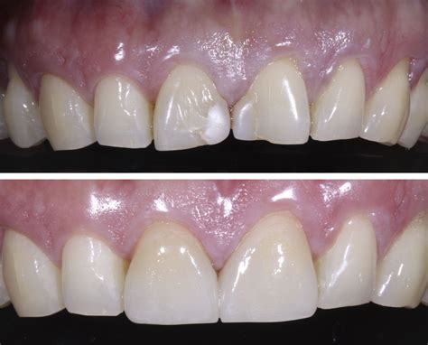 Front Tooth Cavity Filling