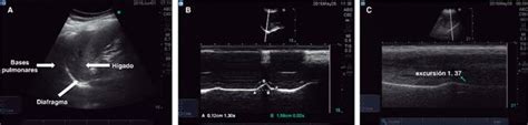 Evaluación ultrasonográfica de la función diafragmática mediante doble