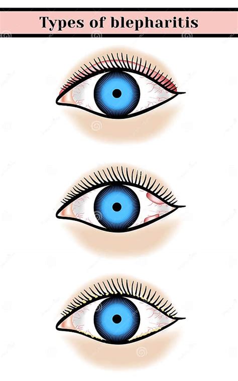 Blepharitis Purulent Inflammatory Eyes Disease Stock Vector