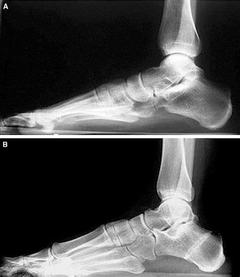 Tibialis Posterior Tendon Dysfunction