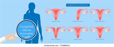 Septate Uterus Uterine Septum Symptoms Treatment 59 OFF