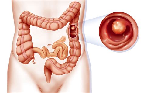 Types Of Colon Polyps And What You Should Know About Them Artofit