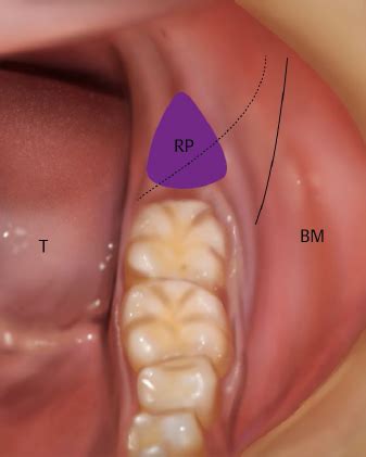 Mucobuccal Fold