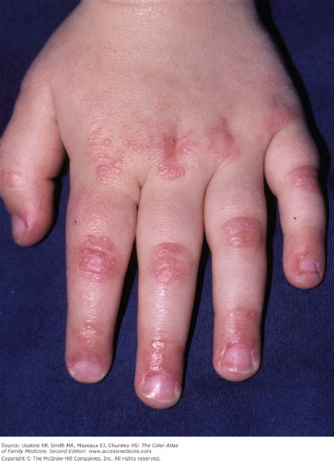 Dermatomyositis Basicmedical Key