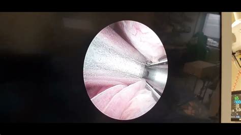 UroLift - What is happening in this clip? Comment below, please. # ...