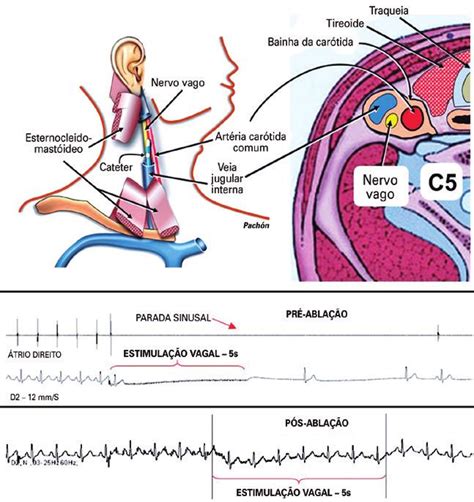 Ablação De Fibrilação Atrial Por Radiofrequência Em Portador De