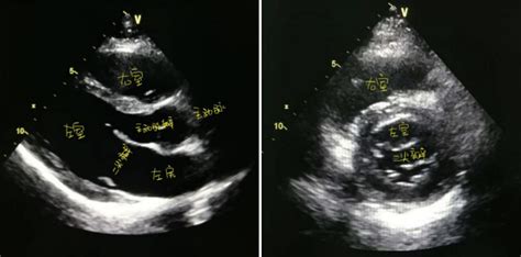 心脏超声报告不会看先熟记这 6 大指标 丁香园