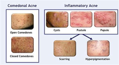 Hyperpigmentation From Acne Necessary Treatment And Warnings