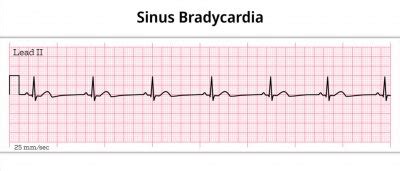 Ecg sinus bradycardia - ecg athlete - 12 leads ecg paper posters for the wall • posters ...