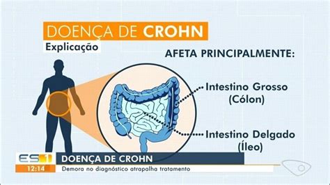 Estv Edi O Saiba O Que A Doen A De Crohn E Como Tratar No Sul