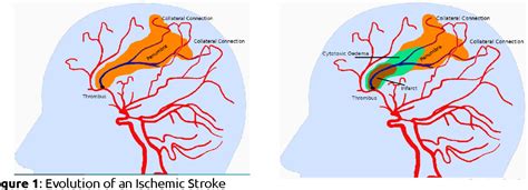 Pdf Ischemic Stroke Patients Semantic Scholar