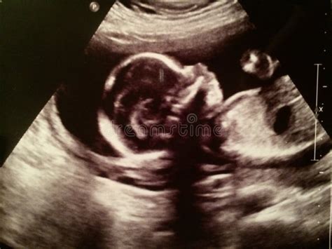 20 Weeks Ultrasound