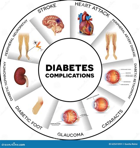 Diabetes Complications Stock Illustration Illustration Of Anatomy