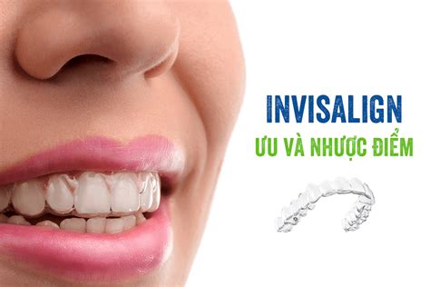 Niềng Răng Trong Suốt Invisalign ưu Và Nhược điểm Cần Biết