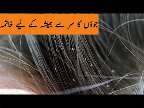 Sar Ki Juen Khatam Karne Ka Tarika Lice And Nits Removal Home Remedy